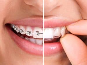 invisalign vs brackets