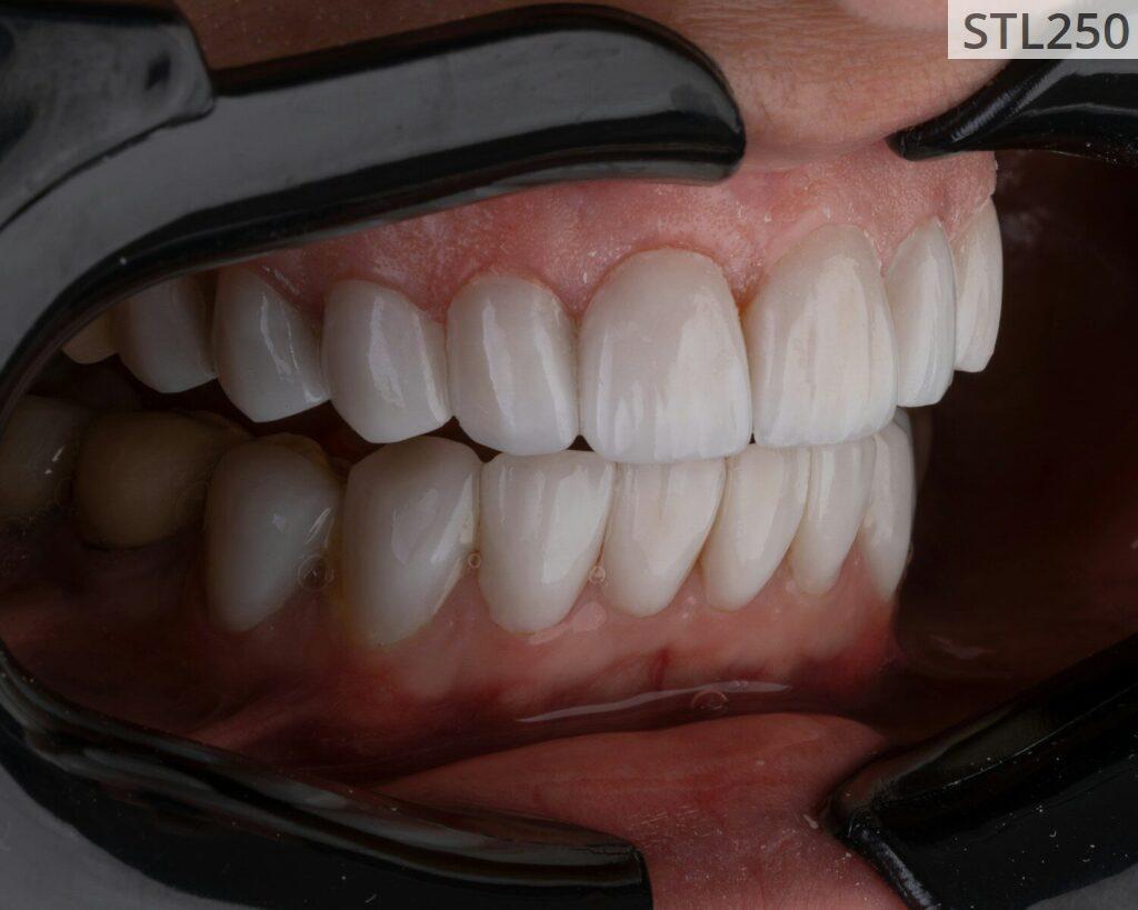 recuperar la sonrisa después de perder una pieza 